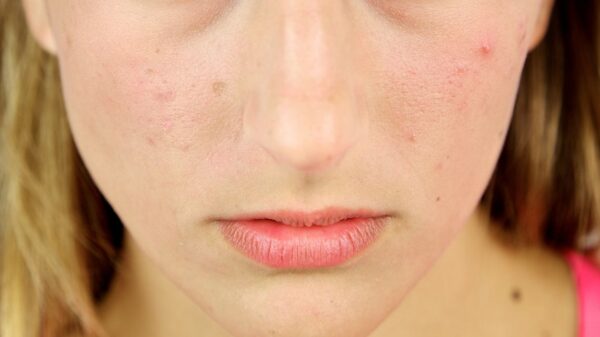 hormonal acne treatment (2)