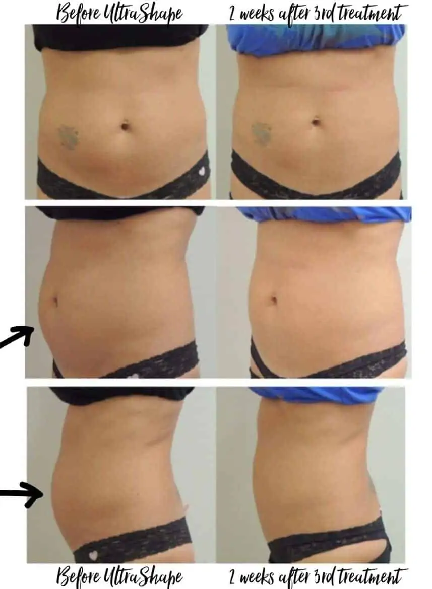 ultrashape results after 3 treatments